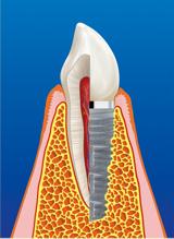 Implant with crown Frialit® (section) - Implants Marburg