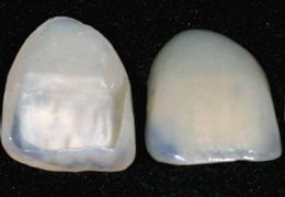 Veneers - Keramik-Haftschalen für perfekte Ästhetik