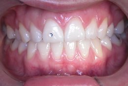 Gesundes Zahnfleisch - attached Gingiva ausreichend breit