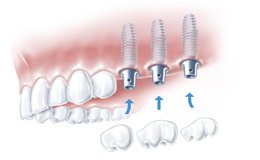 Drei Einzelkronen, die auf Implantate aufgesetzt werden - Zeichnung