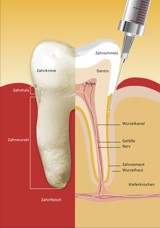 Graphische Darstellung der intraligamentären Anästhesie - es wird direkt in den Parodontalspalt injiziert