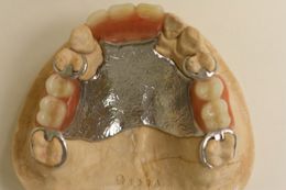 Oberkiefer Teilprothese mit gegossenen Klammern - Modellgussverfahren - Einstück-Gussprothese