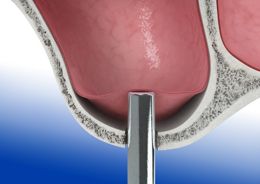 Sinusbodenelevation - Sinuslift und Knochenaugmentation für Zahnimplantate - Perforation des Kieferhöhlenbodens und Anhebung der Kieferhöhlenschleimhaut