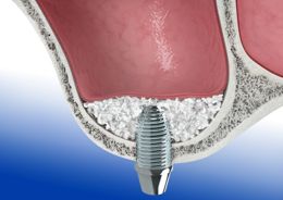 Sinusbodenelevation - Sinuslift und Knochenaugmentation für Zahnimplantate - Enbringen des Knochenersatzmaterials und Implantation