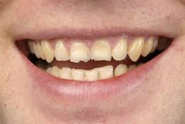 Ein Fall für Veneers