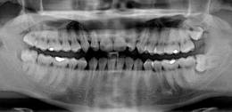 3 verlagerte und retinierte Weisheitszähne auf einer Panorama-Schichtaufnahme, Orthopantomogramm