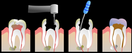 Endodontie Marburg - Der Ablauf einer Wurzelkanalbehandlung - Endo